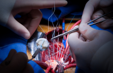 Kardiologie Invasiv Herzschrittmacher